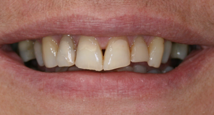 Vorher-Nachher-Bild | Kronen von  Ahmad Saleh | Düsseldorf c0c7c76d Vorher-Bild