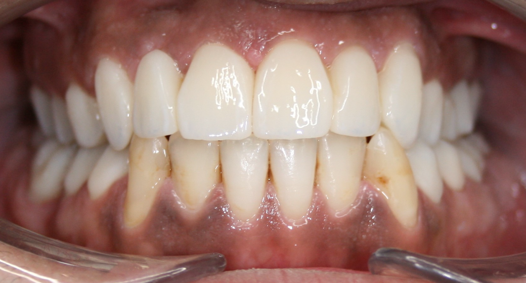 Behandlung Vorher-Nachher-Bild | Bleaching von  Ahmad Saleh | Düsseldorf c0c7c76d Vorher-Bild