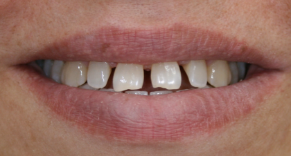 Vorher-Nachher-Bild | Bleaching von  Ahmad Saleh | Düsseldorf c0c7c76d Vorher-Bild