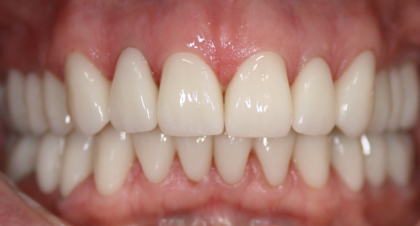 Vorher-Nachher-Bild | Bleaching von  Ahmad Saleh | Düsseldorf c0c7c76d Nachher-Bild