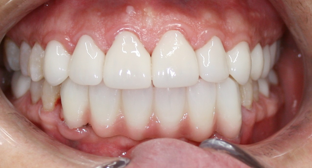 Behandlung Vorher-Nachher-Bild | Kronen von  Ahmad Saleh | Düsseldorf c0c7c76d Vorher-Bild