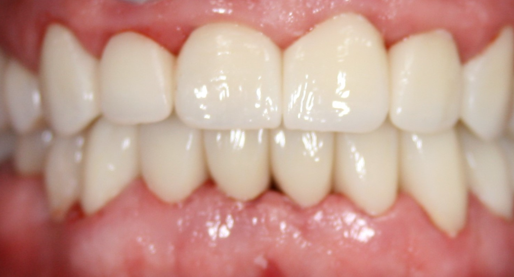 Behandlung Vorher-Nachher-Bild | Brücken von  Ahmad Saleh | Düsseldorf c0c7c76d Vorher-Bild