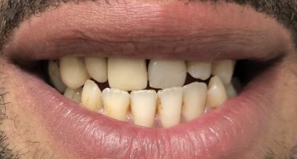 Vorher-Nachher-Bild | Bleaching von  Ahmad Saleh | Düsseldorf c0c7c76d Vorher-Bild