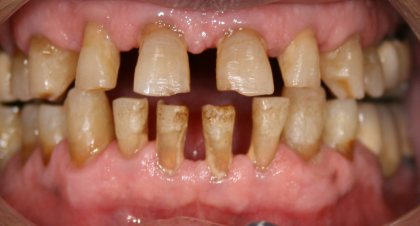 Vorher-Nachher-Bild | Kieferorthopädie von  Ahmad Saleh | Düsseldorf c0c7c76d Vorher-Bild