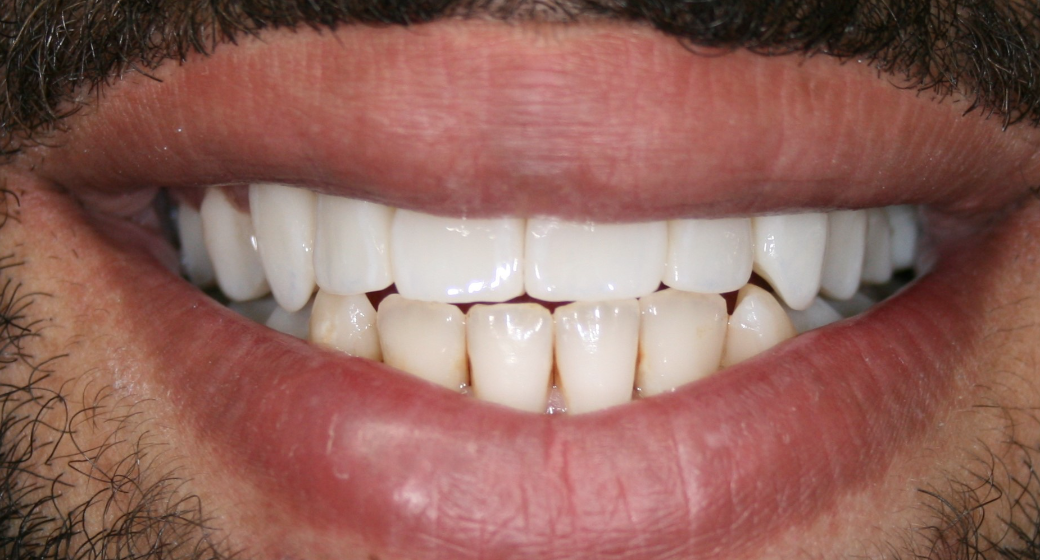 Behandlung Vorher-Nachher-Bild | Bleaching von  Ahmad Saleh | Düsseldorf c0c7c76d Vorher-Bild