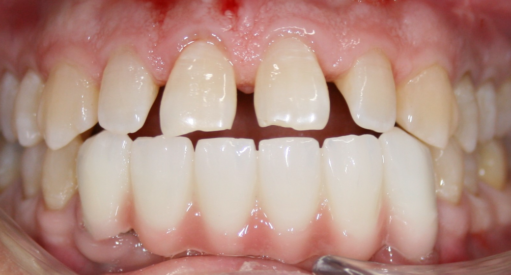 Behandlung Vorher-Nachher-Bild | Kronen von  Ahmad Saleh | Düsseldorf c0c7c76d Nachher-Bild