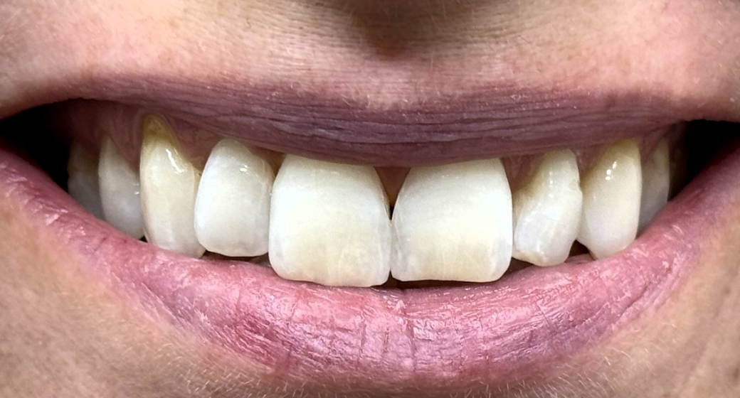 Vorher-Nachher-Bild | Prophylaxe von  Ahmad Saleh | Düsseldorf c0c7c76d Nachher-Bild