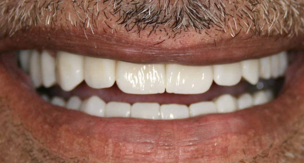 Behandlung Vorher-Nachher-Bild | Bleaching von  Ahmad Saleh | Düsseldorf c0c7c76d Vorher-Bild