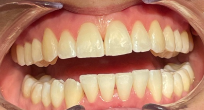 Vorher-Nachher-Bild | Aligner, Bleaching, Prophylaxe, Veneers  | von Dr. med. dent. Kay Zurmühl  | Düsseldorf c0c7c76d Nachher-Bild