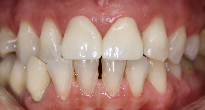 Vorher-Nachher-Bild | Veneers von  Ahmad Saleh | Düsseldorf c0c7c76d Nachher-Bild