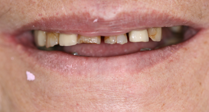 Vorher-Nachher-Bild | Brücken, Füllung, Kronen, Parodontologie, Prophylaxe, Veneers  | von    | Düsseldorf c0c7c76d Vorher-Bild