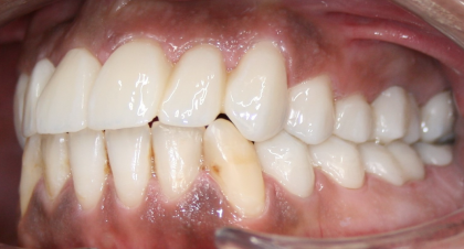 Vorher-Nachher-Bild | Bleaching von  Ahmad Saleh | Düsseldorf c0c7c76d Nachher-Bild