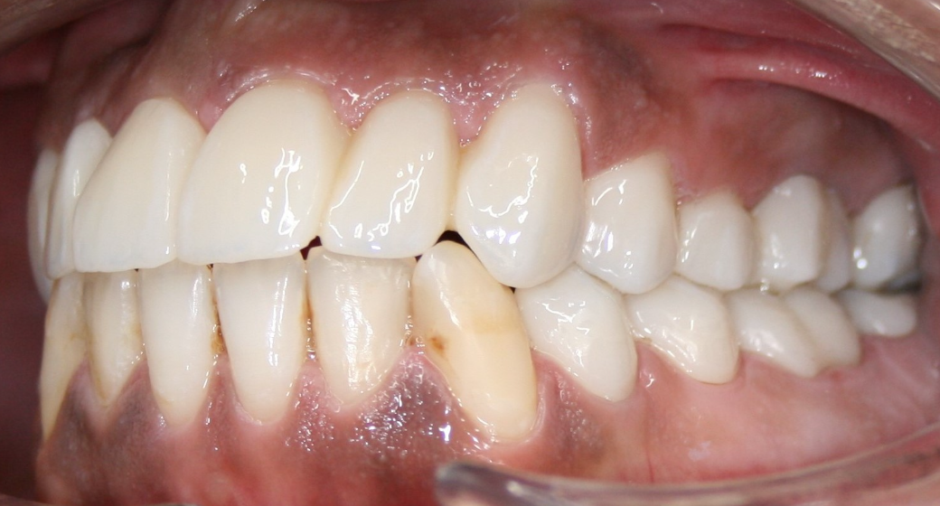 Vorher-Nachher-Bild | Bleaching von  Ahmad Saleh | Düsseldorf c0c7c76d Nachher-Bild