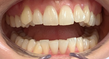 Vorher-Nachher-Bild | Aligner, Bleaching, Prophylaxe, Veneers  | von Dr. med. dent. Kay Zurmühl  | Düsseldorf c0c7c76d Vorher-Bild