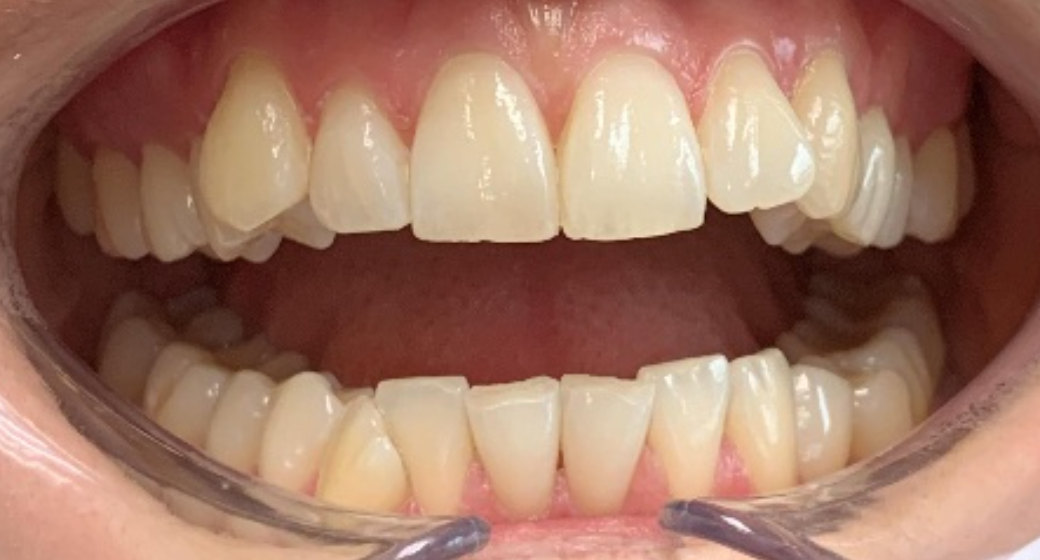 Behandlung Vorher-Nachher-Bild | Aligner, Bleaching, Prophylaxe, Veneers  | von Dr. med. dent. Kay Zurmühl  | Düsseldorf c0c7c76d Nachher-Bild