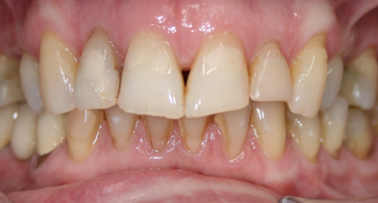 Vorher-Nachher-Bild | Bleaching von  Ahmad Saleh | Düsseldorf c0c7c76d Vorher-Bild