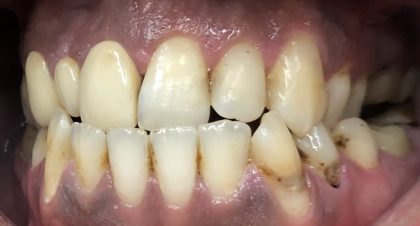 Vorher-Nachher-Bild | Bleaching von  Ahmad Saleh | Düsseldorf c0c7c76d Vorher-Bild