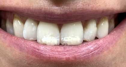 Vorher-Nachher-Bild | Prophylaxe von  Ahmad Saleh | Düsseldorf c0c7c76d Vorher-Bild