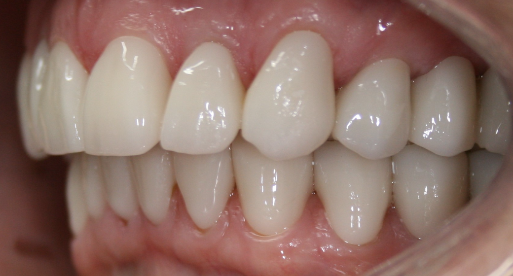 Behandlung Vorher-Nachher-Bild | Brücken von  Ahmad Saleh | Düsseldorf c0c7c76d Vorher-Bild