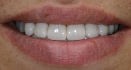 Vorher-Nachher-Bild | Bleaching von  Ahmad Saleh | Düsseldorf c0c7c76d Nachher-Bild