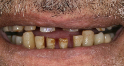 Vorher-Nachher-Bild | Bleaching von  Ahmad Saleh | Düsseldorf c0c7c76d Vorher-Bild