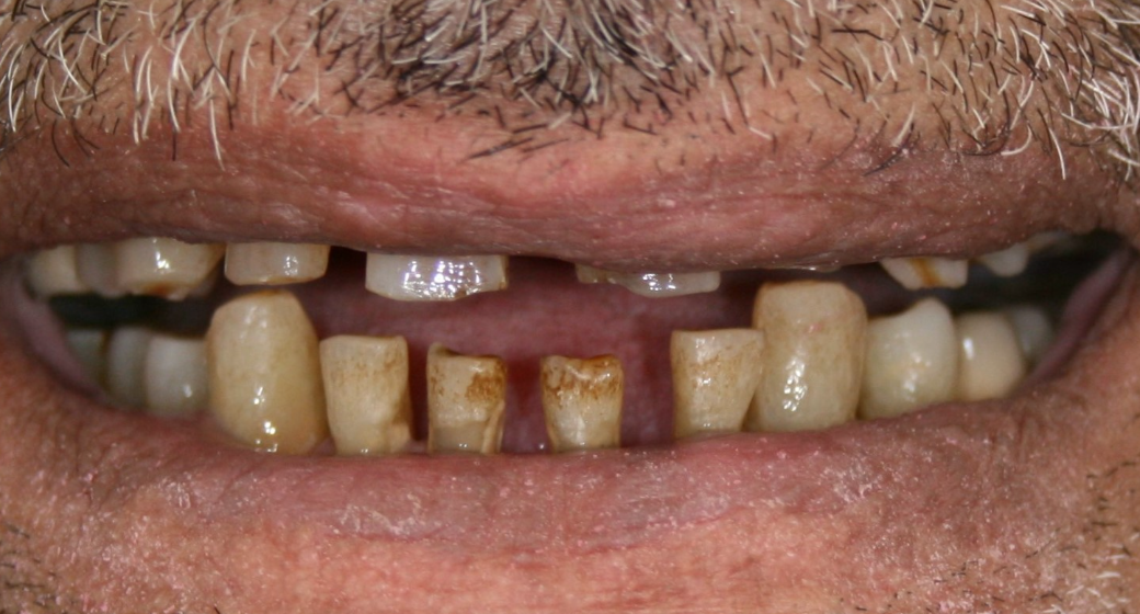 Behandlung Vorher-Nachher-Bild | Bleaching von  Ahmad Saleh | Düsseldorf c0c7c76d Nachher-Bild