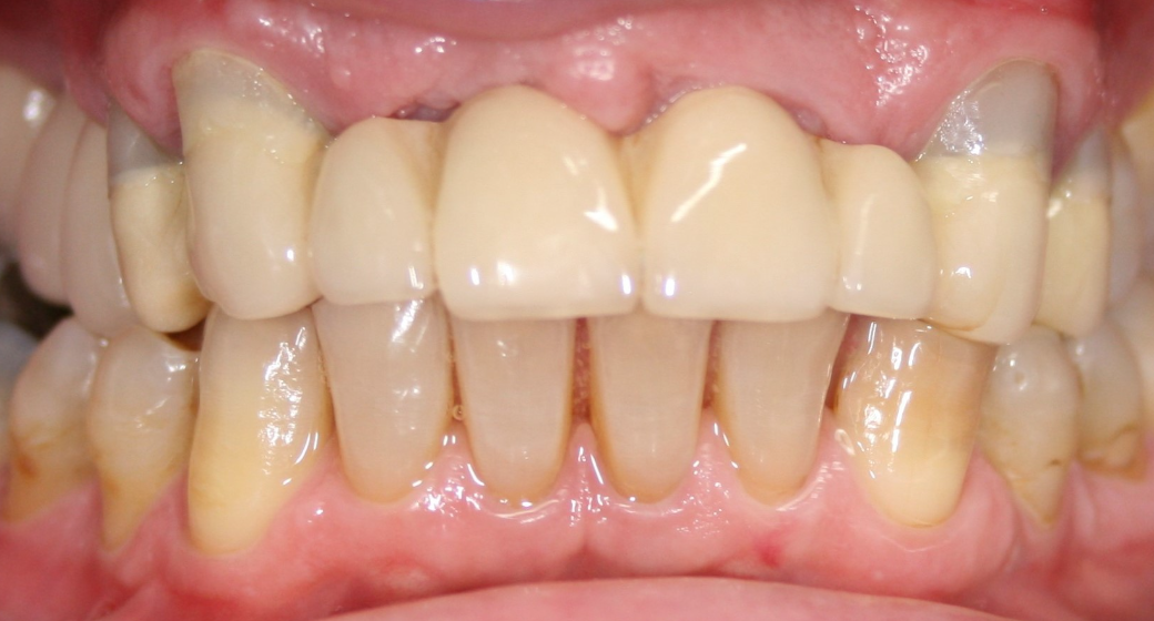 Behandlung Vorher-Nachher-Bild | Brücken von  Ahmad Saleh | Düsseldorf c0c7c76d Nachher-Bild