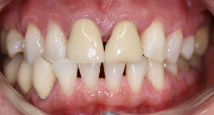 Vorher-Nachher-Bild | Veneers von  Ahmad Saleh | Düsseldorf c0c7c76d Vorher-Bild