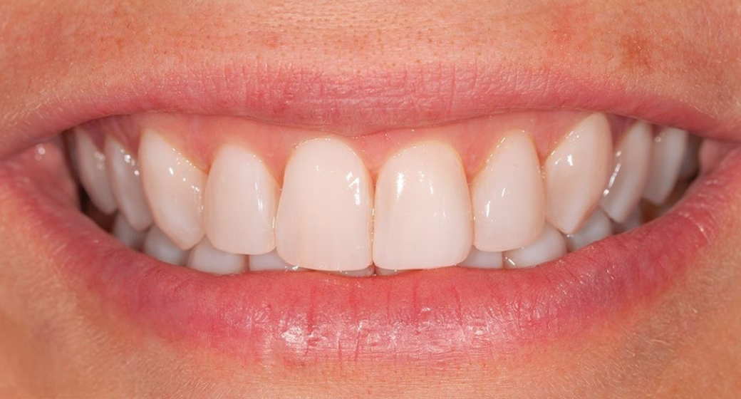 Behandlung Vorher-Nachher-Bild | Veneers von Dr. med. dent. Frank-Christoph Langer | Sankt Augustin cee63112 Vorher-Bild