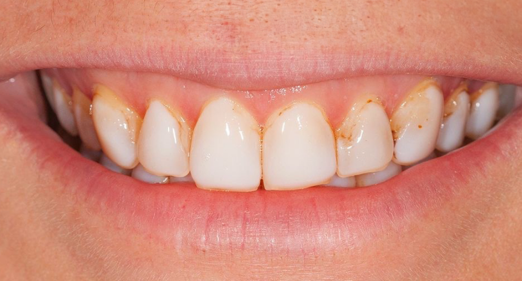 Behandlung Vorher-Nachher-Bild | Veneers von Dr. med. dent. Frank-Christoph Langer | Sankt Augustin cee63112 Nachher-Bild