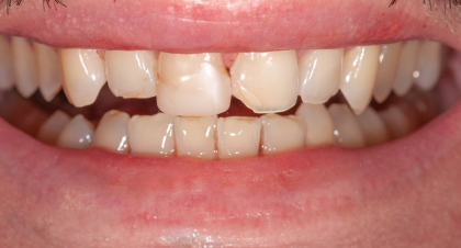 Vorher-Nachher-Bild | Veneers von Dr. med. dent. Frank-Christoph Langer | Sankt Augustin cee63112 Vorher-Bild