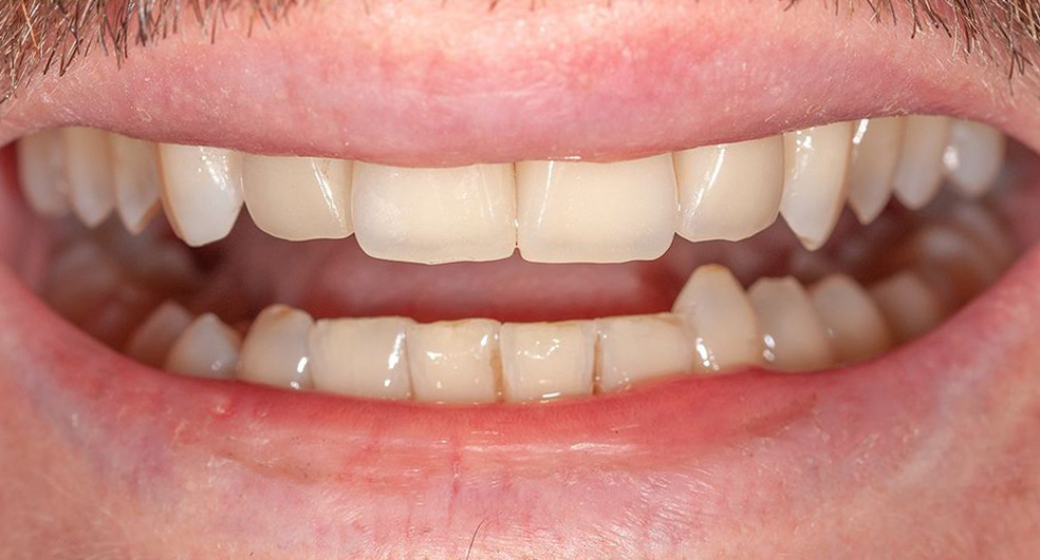 Behandlung Vorher-Nachher-Bild | Veneers von Dr. med. dent. Frank-Christoph Langer | Sankt Augustin cee63112 Vorher-Bild