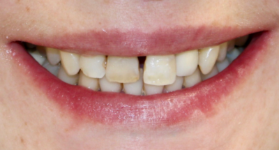 Vorher-Nachher-Bild | Implantate  | von Dr. med. dent. Stefan  Ursu | Creußen d645920e Vorher-Bild