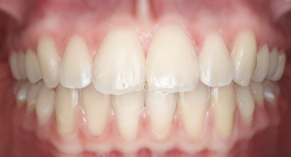 Vorher-Nachher-Bild | Kieferorthopädie von Dr. med. dent. Neda Yavari | Elmshorn d82c8d16 Nachher-Bild