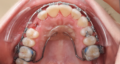 Vorher-Nachher-Bild | Kieferorthopädie | von Dr. Neda Yavari | Elmshorn d82c8d16 Nachher-Bild