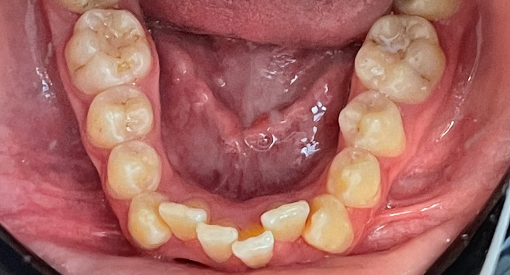 Behandlung Vorher-Nachher-Bild | Kieferorthopädie  | von Dr.  Neda Yavari | Elmshorn d82c8d16 Nachher-Bild