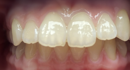 Vorher-Nachher-Bild | Kieferorthopädie von Dr. med. dent. Neda Yavari | Elmshorn d82c8d16 Vorher-Bild