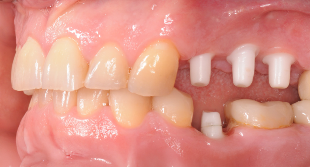 Behandlung Vorher-Nachher-Bild | Implantate von Dr. med. dent. Gero Böthig | Bernried am Starnberger See d9d4f495 Nachher-Bild
