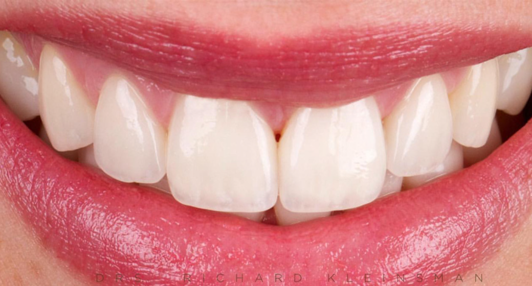 Behandlung Vorher-Nachher-Bild | Parodontologie, Veneers  | von drs.  Richard  Kleinsman  | Bocholt  e2c420d9 Vorher-Bild