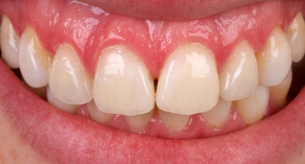 Behandlung Vorher-Nachher-Bild | Parodontologie, Veneers | von drs. Richard Kleinsman | Bocholt e2c420d9 Nachher-Bild