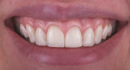 Vorher-Nachher-Bild | Gummy Smilevon Dr. med. dent. Soeren Pinz, M.Sc. | Krefeld ef575e88 Vorher-Bild