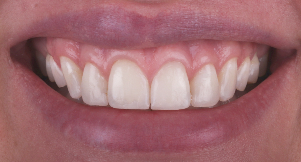 Behandlung Vorher-Nachher-Bild | Gummy Smilevon Dr. med. dent. Soeren Pinz, M.Sc. | Krefeld ef575e88 Nachher-Bild