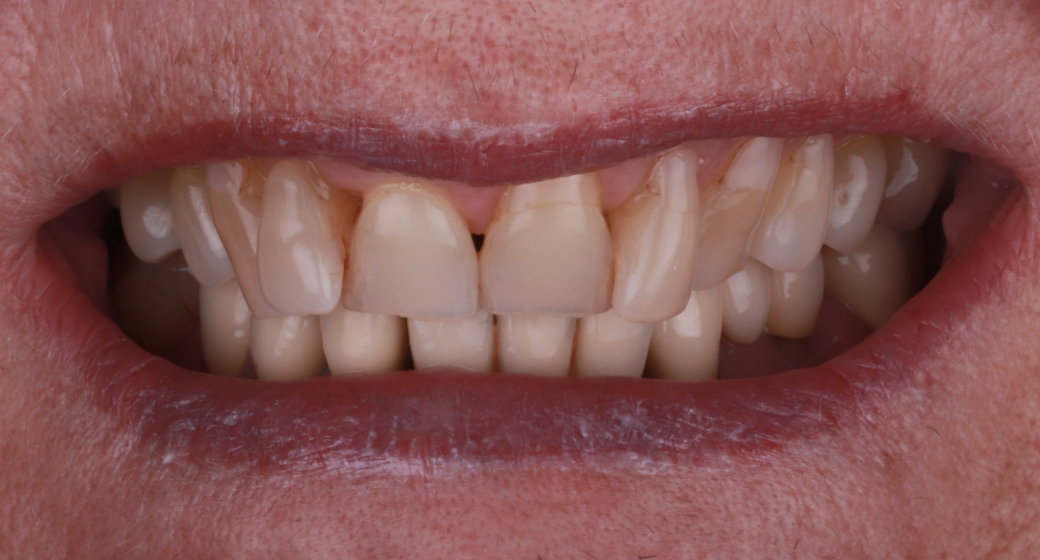 Behandlung Vorher-Nachher-Bild | Veneersvon Dr. med. dent. Soeren Pinz, M.Sc. | Krefeld ef575e88 Nachher-Bild