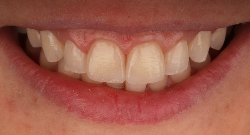 Behandlung Vorher-Nachher-Bild | Veneersvon Dr. med. dent. Soeren Pinz, M.Sc. | Krefeld ef575e88 Vorher-Bild
