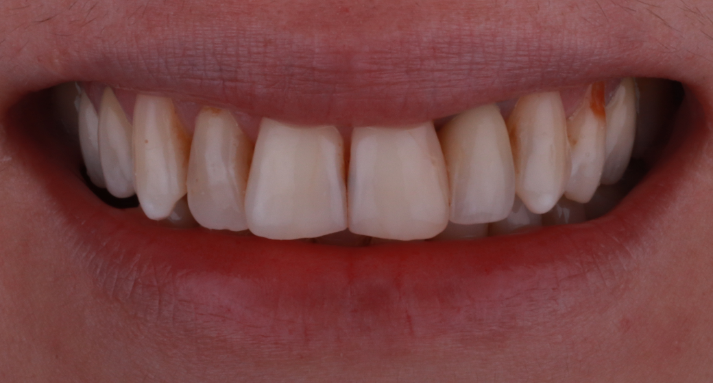 Behandlung Vorher-Nachher-Bild | Kronenvon Dr. med. dent. Soeren Pinz, M.Sc. | Krefeld ef575e88 Nachher-Bild