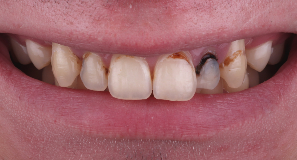 Behandlung Vorher-Nachher-Bild | Veneersvon Dr. med. dent. Soeren Pinz, M.Sc. | Krefeld ef575e88 Nachher-Bild