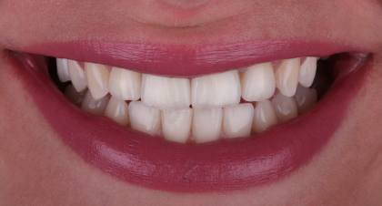 Vorher-Nachher-Bild | Implantatevon Dr. med. dent. Soeren Pinz, M.Sc. | Krefeld ef575e88 Nachher-Bild