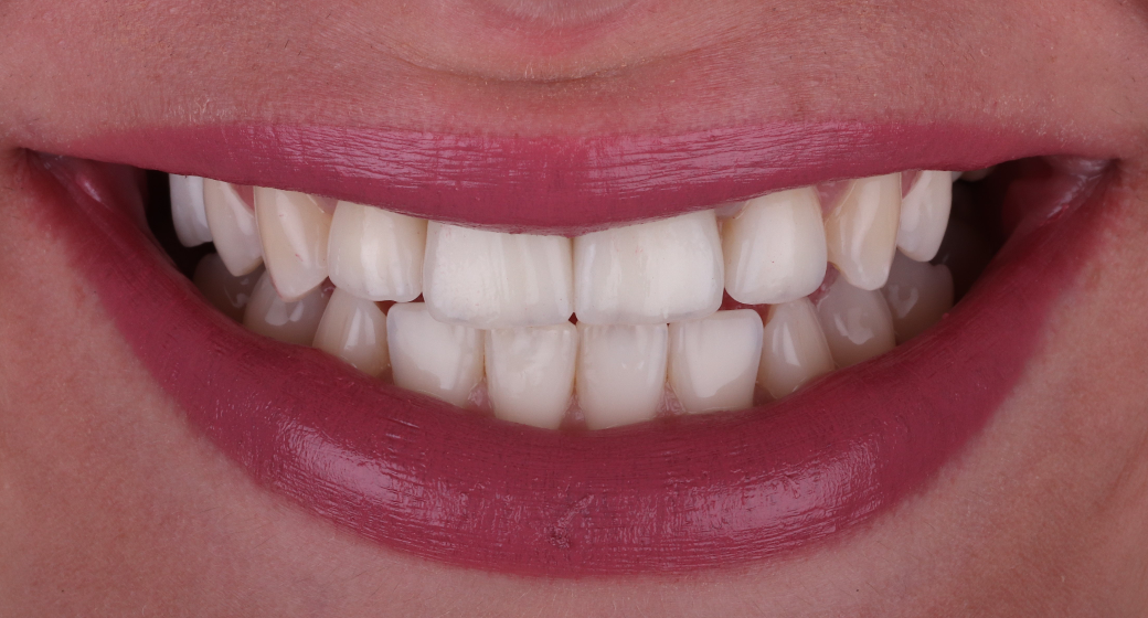 Behandlung Vorher-Nachher-Bild | Implantatevon Dr. med. dent. Soeren Pinz, M.Sc. | Krefeld ef575e88 Vorher-Bild