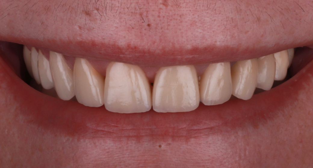 Behandlung Vorher-Nachher-Bild | Kronenvon Dr. med. dent. Soeren Pinz, M.Sc. | Krefeld ef575e88 Vorher-Bild