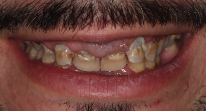 Vorher-Nachher-Bild | Implantatevon Dr. med. dent. Soeren Pinz, M.Sc. | Krefeld ef575e88 Vorher-Bild
